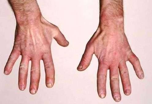 HAV hand symptoms image